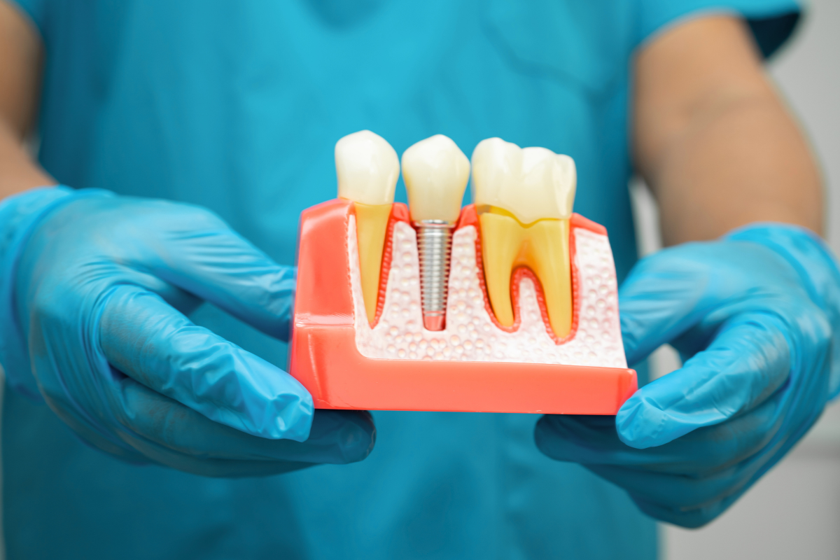 A Guide To Understanding Dental Implants
