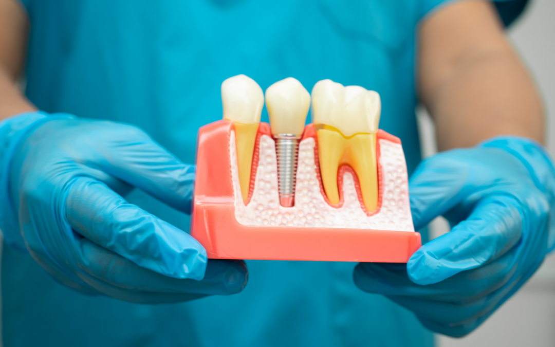 Can You Have 2 Dental Implants Next to Each Other?