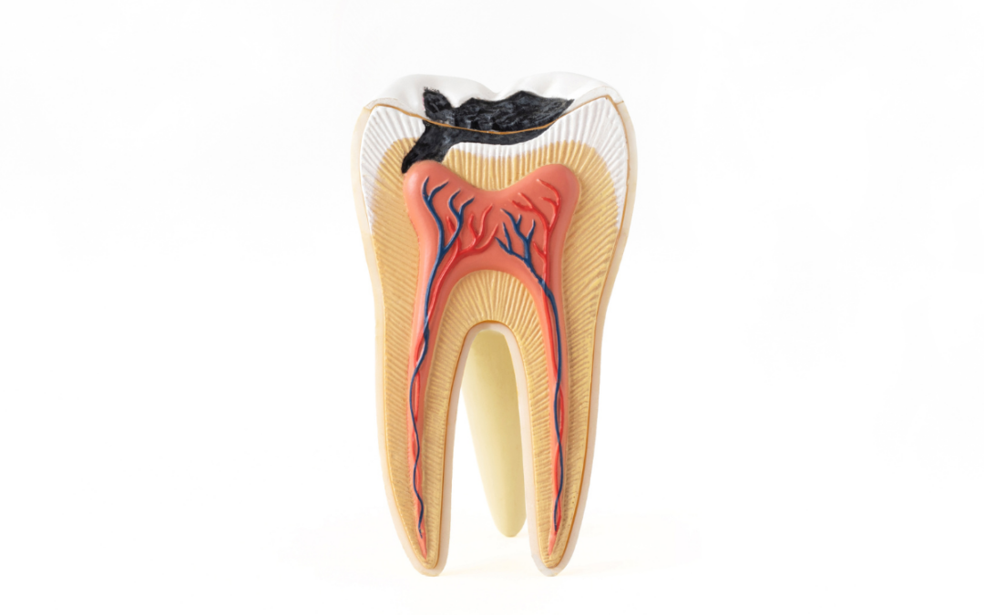 Root Canal Aftercare Tips: Dos and Don’ts for Anderson Residents